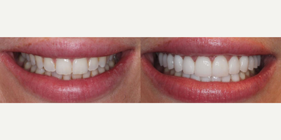 Woman treated with Smile Makeover - Woman treated with Smile Makeover using 12 upper minimal and no prep veneers as well as 6 lower veneers, shown immediately after the treatment. Her smile was also broadened, gum asymmetry was corrected using laser s well as some crowding on the lowers.