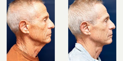 65-74 year old man treated with Neck Lift - 65-74 year old man treated with Neck Lift