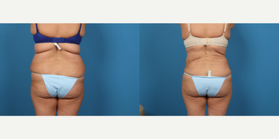 45-54 year old woman treated with Vaser Liposuction, Liposuction - Patient is shown one month liposuction from abdomen, flanks and bra-line