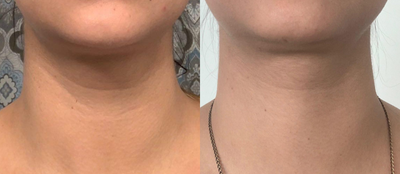 35-44 year old woman treated with Forma - Forma Neck treatment:Forma uses radio-frequency technology to provide optimal skin contraction in the deep layers of your skin. Radio-frequency energy will stimulate the formation of new collagen and improve skin elasticity. Forma smoothes and tightens the skin to reduce fine lines and wrinkles, reversing the effects of aging and sun damage. Its completely painless and there is no downtime.After 3 session.
