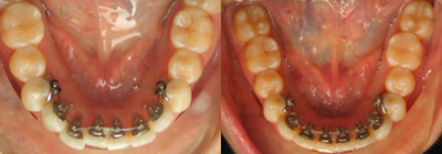 Incognito (Behind The Teeth) Lingual Braces - Incognito (Behind the Teeth) Lingual braces to correct lower anterior crowding.&nbsp;