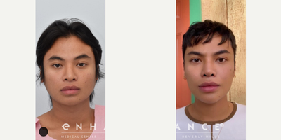 Man treated with Jaw Reduction - This patient had a rib rhinoplasty, jaw shaving and a chin implant.