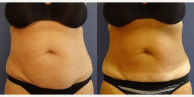 Woman treated with SculpSure - Woman treated with SculpSure
