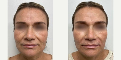 55-64 year old woman treated with 1.5 cc syringe of Radiesse. - Radiesse Injection to the smile lines. Patient was treated with 1.5 cc syringe. Before and After taken immediately after treatment
