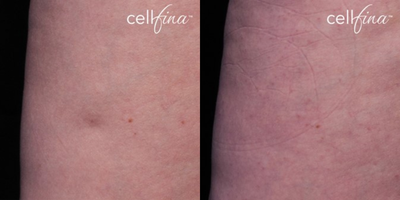 25-34 year old woman treated with Cellfina - 27-year-old female patient treated for cellulite on thighs.