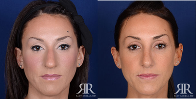 Rhinoplasty - Rhinoplasty