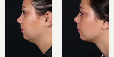 Double Chin CoolMini - Results shown after 2 sessions of CoolMini for a double chin