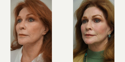 69 year old woman treated with Renuvion - This 69 year-old woman from Prescott, AZ travelled to our office in Gilbert, AZ for consultation regarding facial rejuvenation surgery. Dr. Olson examined her and after listening to her concerns recommend full facial skin resurfacing with J plasma as well as fat grafting to her face.The procedure was performed under twilight anesthesia and she is shown her three months after surgery when much smooth skin with fewer wrinkles and better skin texture. Fat was suctioned from her abdomen and injected over the cheek bones and around her mouth for a more youthful appearance. She has some faint redness that will continue to fade over the next month.