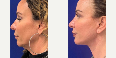 49 year old woman treated with Eyelid Surgery - 49 year old woman treated with Eyelid Surgery