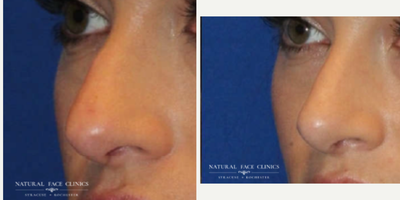 35-44 year old woman treated with Rhinoplasty - Patient had nasal tip refinement, hump reduction, and asymmetry columella (base of nose).