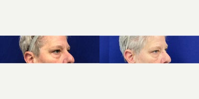 55-64 year old woman treated with Agnes RF - Upper Eyelid Tightening and Lower Eyelid debulking and Tightening