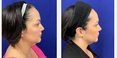 35-44 year old woman treated with Agnes RF - Submental debulking, Jowl debulking, and jawline tightening