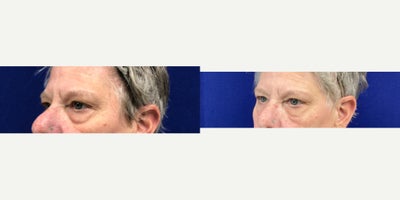 55-64 year old woman treated with Agnes RF - Upper Eyelid Tightening and Lower Eyelid debulking and Tightening