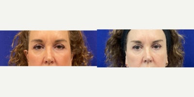 65-74 year old woman treated with Agnes RF - Upper Eyelid tightening
