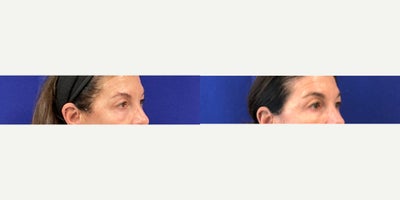 55-64 year old woman treated with Agnes RF - Upper and Lower Eyelid Tightening