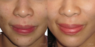 Face Age Spots Treatment using Chemical Peel - Solar lentigos, commonly called dark spots or age spots, are flat brown spots caused by sun exposure. They may be present all over the body surface, especially in the areas most exposed to UV rays. This condition can be effectively treated with chemical peels.