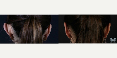 Woman treated with Ear Surgery - Woman treated with Ear Surgery