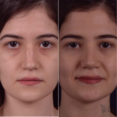 Woman treated with Rhinoplasty - Woman treated with Rhinoplasty