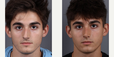 Woman treated with Rhinoplasty - Dr Marottas expert technique and attention to detail is showcased in this remarkable before and after transformation.This rhinoplasty has enhanced the natural look of this handsome young man, achieving a nice strong straight profile, and improvement in the dorsal lines and nasal tip complex. These results are a reflection of Dr Marottas commitment to aesthetic excellence.