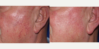 65-74 year old man treated with vascular Laser - Unwanted red vessels can create embarassment when the face is 'too red'. Use of our Varilight or Diolight can specifically target individual capillaries, immediately shrinking them. Discomfort is mild to modest, and treatment is quick with no downtime. Two treatments achieves best results.