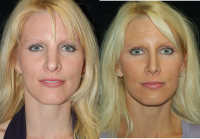 Revision Rhinoplasty - The pateint had a prior open rhinoplasty that left her with a large, wide nose. I performed a revision rhinoplasty (closed technique) in order to create a more elegant and beautiful nose.
