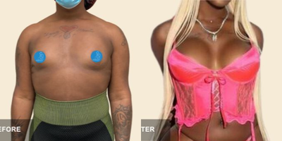25-34 year old transgender woman treated with Breast Augmentation - 25-34 year old transgender woman treated with Breast Augmentation
