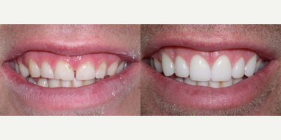 Gum surgery and six porcelain veneers. - Patient had very short teeth. This&nbsp;result was from a combination of gum surgery and six porcelain veneers.