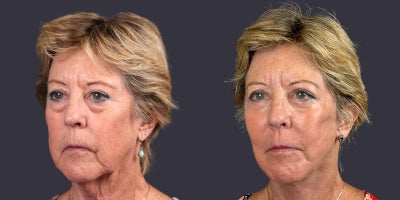 65-74 year old woman treated with Facelift, Eyelid Surgery, CO2 Laser, Skin Rejuvenation, Lower Facelift, Neck Lift, SMAS Faceli - This 68 year old woman is 5'2 and 129 pounds. She presented requesting facial rejuvenation. She had a deep plane - SMAS facelift and neck lift, lower eyelid blepharoplasty, corner of the mouth lift, and central face skin rejuvenation with CO2 laser resurfacing.