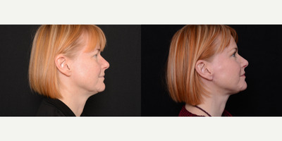 Woman treated with Neck Lift - Woman treated with Neck Lift