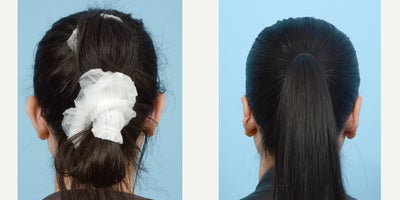 35-44 year old woman treated with Earfold - otoplasty