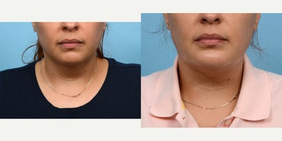 35-44 year old woman treated with Chin Surgery - A double chin and inadequate projection were the reasons this 37-year-old patient sought out Dr. Wise. Seven weeks after her combination chin implant/ submental liposuction surgery, she absolutely loves the definition and contour of her new jawline!