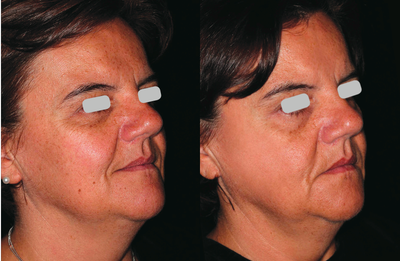 ResurFX - Photo provided courtesy of Lumenis, Ltd., performed by Matteo Tretti Clementoni, MD