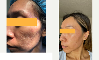 35-44 year old woman treated with MiXto Laser, Laser Resurfacing, Sculptra, Bellafill - Laser resurfacing is combined with subcision, and fillers such a sculptra And bellafill. Two treatments were performed six months apart and this is the patient one year later with significant improvement.