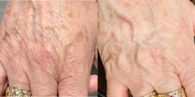 55-64 year old woman treated with Pixel Laser, Hand Rejuvenation, BroadBand Light (BBL) - HALO Laser for treating sun damage, age spots and hyperpigmentation. Also improved crepey skin for a smoother more supple appearance.