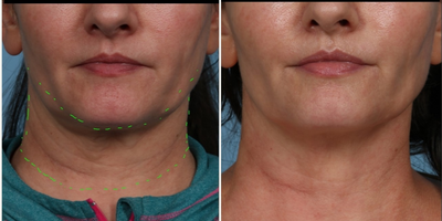 45-54 year old woman treated with Microneedling RF, Secret RF, Microneedling, Skin Tightening - Our 52 year old patient was so happy with her results after only 2 Genius RF jawline and neck treatments that she wanted to share her results with you.  Notice the dramatic skin tightening seen in her neck skin with improved skin elasticity and texture.   Her jawline is further contoured by her Sculptra injections in her cheeks and jawline.  Today she is having her 3rd Genius RF and Sculptra treatment so she will see even more results over the next 6 weeks.  We cant wait to see her back on follow up.
