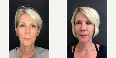 Woman treated with Mini Facelift - Woman treated with Mini Facelift