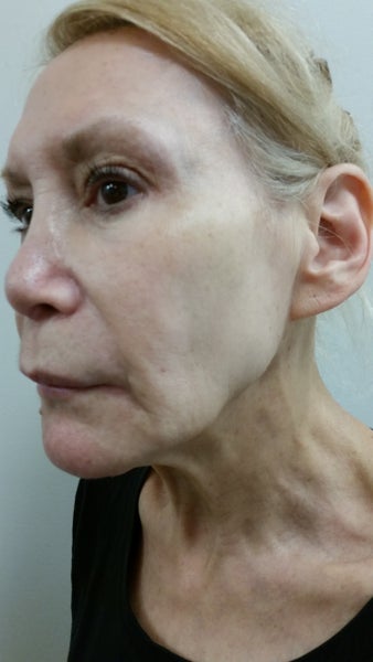 Learning The Difference Between Skin Tightening and Soft Lift: Rejuvenate  with Pacific Derm - Pacific Derm