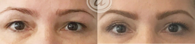 35-44 year old woman treated with Sofwave - Sofwave for upper eyelid lifting