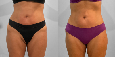 45-54 year old woman treated with Emsculpt - This woman in her early fifties was interested in building ab muscle and toning her glutes. She met with our body contouring specialist who recommended four sessions of Emsculpt Neo. After her treatments, she says she has felt stronger, and she looks great pictured before and three months after completion.