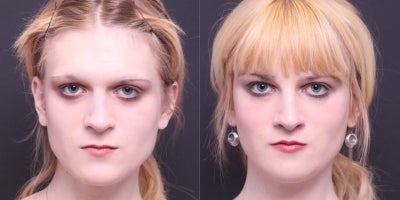 25-34 year old transgender woman treated with Facial Feminization Surgery - Fat grafting to the face, brow bone reduction, frontal brow lift, hairline advancement, upper lip lift with augmentation, mandible/chin contouring