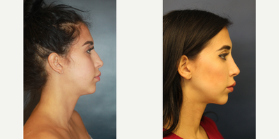 25-34 year old woman treated with Rhinoplasty - 26 year old woman treated with a closed rhinoplasty (no external scars)