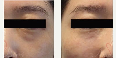35-44 year old woman treated with Juvederm, Volbella, Voluma, Restylane - 4D Under Eye Lift - Treatment of dark circles & bags under eyes and cheek restoration with Belotero, Restylane, Volbella and Voluma
