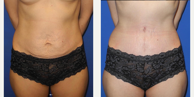 35-44 year old woman treated with Tummy Tuck - 35-44 year old woman treated with Tummy Tuck- 6 weeks post-op