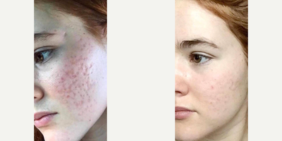 Woman treated with Vampire Facial - Woman treated with Vampire Facial