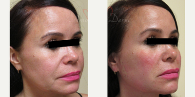45-54 year old woman treated with Thread Lift in lower and mid-face - Patient underwent non-surgical Thread Lift with absorbable PDO threads in lower face (jowl) and mid-face areas (nasolabial folds).