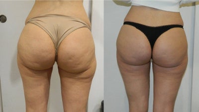 35-44 year old woman treated with Carboxytherapy - 35-44 year old woman treated with 10 sessions of carboxytherapy