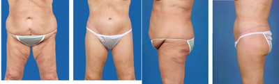 Lower body lift and tummy tuck post gastric bypass surgery - age 57 - 
	post gastric bypass
