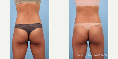 35-44 year old woman treated with Emsculpt - After photo was taken after patient completed her last session of Emsculpt treatment to her abdomen and buttocks.  Patient received a total of 4 sessions of Emsculpt within 2 weeks.