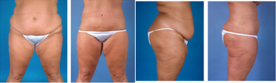 Central body lift with liposuction age 32 - 
