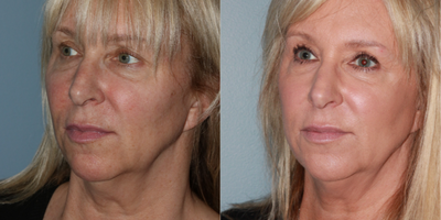 54 year old woman treated with Silhouette InstaLift - The Silhouette InstaLift was performed as an alternative to a surgical facelift for facial rejuvenation of the mid-lower face.